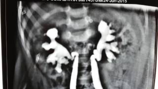 Bilateral Vesicoureteral reflux VUR Note prominent renal pelvis [upl. by Merritt825]