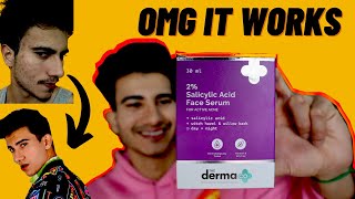 Derma Co Salicylic Acid  Review in Hindi  dermaco honestreview  the derma co salicylic acid [upl. by Etterual]