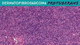 DFSP with perfect storiform pattern Fibrosarcomatous Dermatofibrosarcoma Protuberans Yale case 6 [upl. by Ecargyram342]