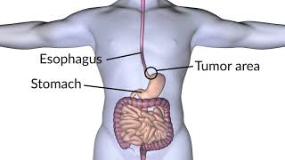 Esophagectomy performed by Dr John Hunter  OHSU [upl. by Gayler]