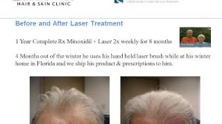 PRP Hair Loss Treatments Berkowits Review [upl. by Fairfield]