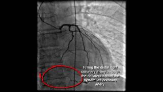 The second stent placement in circumflex artery of the heart Live case [upl. by Eltsirhc]