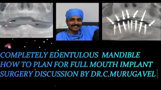 Completely edentulous mandible  how to plan for full mouth implant surgery [upl. by Okime611]