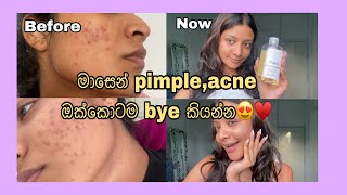 මම Pimples acne නැතිකරගත්තෙ මෙහෙමයි ☺️how I cleared my acne  sapna padukka [upl. by Laenahtan]