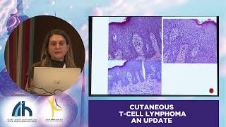 CHALLENGES IN DIAGNOSIS OF MYCOSIS FUNGOIDES  Dr Evangelia Papadavid [upl. by Rratsal]