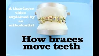 How braces move teeth timelapse  Braces Explained [upl. by Robinet]