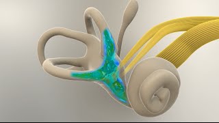 Menieres Disease  What Happens in the Inner Ear [upl. by Suez]