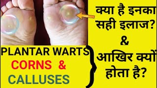 Plantar warts Corns amp Calluses Causes Symptoms amp Treatment [upl. by Rich]