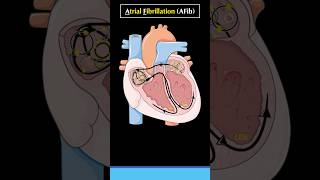 What is Atrial Fibrillation AF or AFib atrialfibrillation cardiology arrhythmia heart [upl. by Silevi]