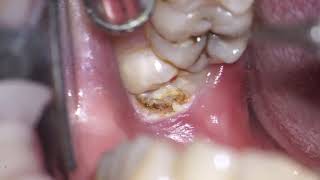 operculectomy of mn 3dr molar [upl. by Llertrac]