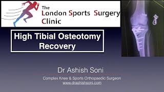 High Tibial Osteotomy recovery [upl. by Nidnerb388]