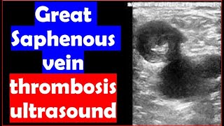 Great Saphenous vein thrombosis Ultrasound [upl. by Marguerie]