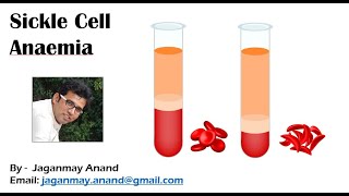 Sickle Cell DiseaseSickle Cell Anaemia [upl. by Forest]