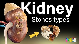 TYPES OF KIDNEY STONES [upl. by Marga]