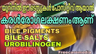 Bilirubin test in urine Bile pigments  Bile salt  Urobilinogen liver disease urine [upl. by Miharbi]