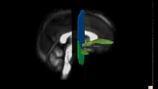 Delineation of the Uncinate Fasciculus [upl. by Ralleigh]