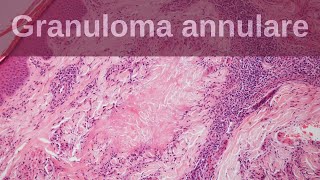 Granuloma Annulare  Pathology mini tutorials [upl. by Eerihs]