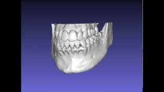 3D Jaw model created from CT scan [upl. by Hamian906]