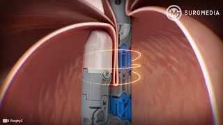 Endoscopic Treatment for GastroEsophageal Reflux Disease GERD or known as Acid Reflux [upl. by Yelich]