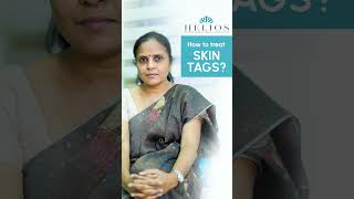 How to treat Skin Tag  Skin Tag removal  TAMIL  Dr Yamini  Helios skin hair amp laser clinic [upl. by Pimbley]