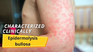 Epidermolysis bullosa  Symptoms and causes [upl. by Breger]