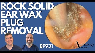 ROCK SOLID EAR WAX PLUG REMOVAL  EP931 [upl. by Arabrab]