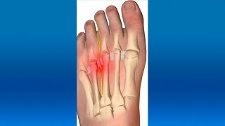 🦶🏻 Que es la METATARSALGIA causas sintomas y tratamiento [upl. by Tnilc]