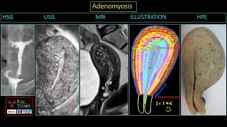 MUSA in AdenomyosisImaging and Illustrations [upl. by Drew240]