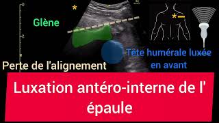 Luxation antérointerne de lépaule Glénohumérale Échographie [upl. by Alburga889]