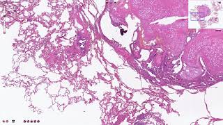 Pulmonary Hamartoma  Histopathology [upl. by Daley931]