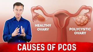 3 Causes of Polycystic Ovarian Syndrome PCOS amp High Androgens – Dr Berg [upl. by Win523]