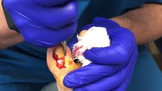 Minimally Invasive Ingrown Toenail Removal Ingrown Toenail [upl. by Walter]