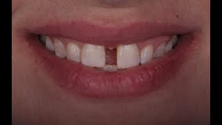 A combined approach for diastema closure [upl. by Britteny260]