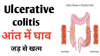 Ulcerative colitis  Traetment and Symptoms  Colistis ko theek kaise kare [upl. by Howzell274]