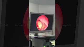 Endoscopic Polyp removal done by Dr Bilal  Supreme Hospital [upl. by Randal]