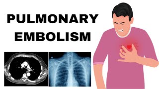 Pulmonary Embolism Pathophysiology Etiology Symptoms Diagnosis amp Treatment [upl. by Stuppy]