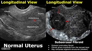 Uterus Ultrasound Normal Vs Subserosal Fibroid Images  Uterine Leiomyomas Cases  Pelvic USG Cases [upl. by Refinnej]