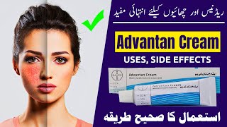 Advantan Cream Uses Benefits and Side Effects Discussed [upl. by Jahdol]