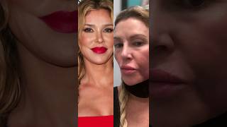 RHOBH Brandi Glanville SHOCKING Severe Face Swelling [upl. by Christie]