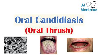 Oral Candidiasis Oral Thrush  Causes Pathophysiology Signs amp Symptoms Diagnosis Treatment [upl. by Nairadas]