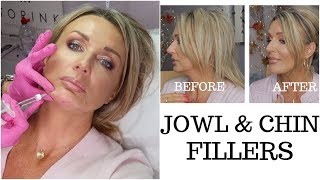 Jowls and Chin Fillers with Before And After Photos  my experience [upl. by Autrey]