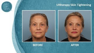 Ultherapy and Microcurrent device for skin tightening [upl. by Llednohs]