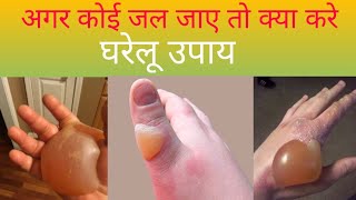 soframycin Cream uses in hindi। जल जाने पर क्या करे। soframycin कब use krte है [upl. by Iras]