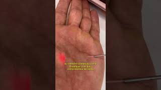 ENDOLASER  Elyon Dual Cromatic  Laser Subdérmico  Tudo Belo Estética [upl. by Yllehs]