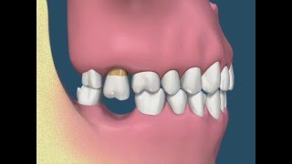 Perda dental e suas consequências  vídeo 1 [upl. by Tamma217]