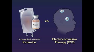 Ketamine vs ECT for Major Depression  NEJM [upl. by Eclud]