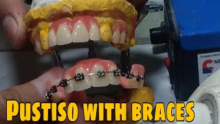 Denture with Retainer like braces w Gums Pustiso with braces in the Philippines [upl. by Htebazie]