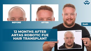 1 Year After Hair Transplant  ARTAS Robotic FUE [upl. by Meurer]