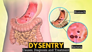 What is Dysentery Causes Signs and symptoms Diagnosis and treatment [upl. by Etnor526]