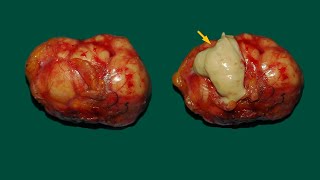 Pancreas lymphoepithelial cysts different features different location [upl. by Selia]